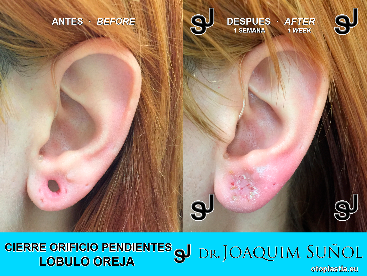 cierre orificios pendientes lobulos de la oreja - Resultados reales de antes y despues