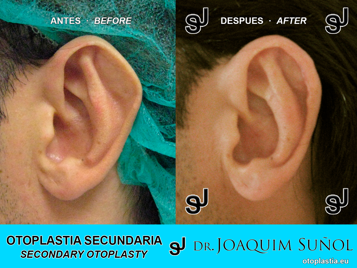 Reoperacion de orejas - otoplastia secundaria: Resultados reales Antes y Despues - Dr. Joaquim Suñol