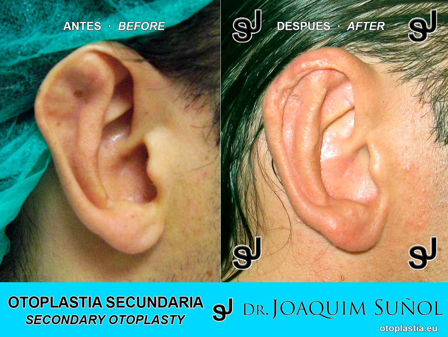 Reoperacion de orejas - otoplastia secundaria