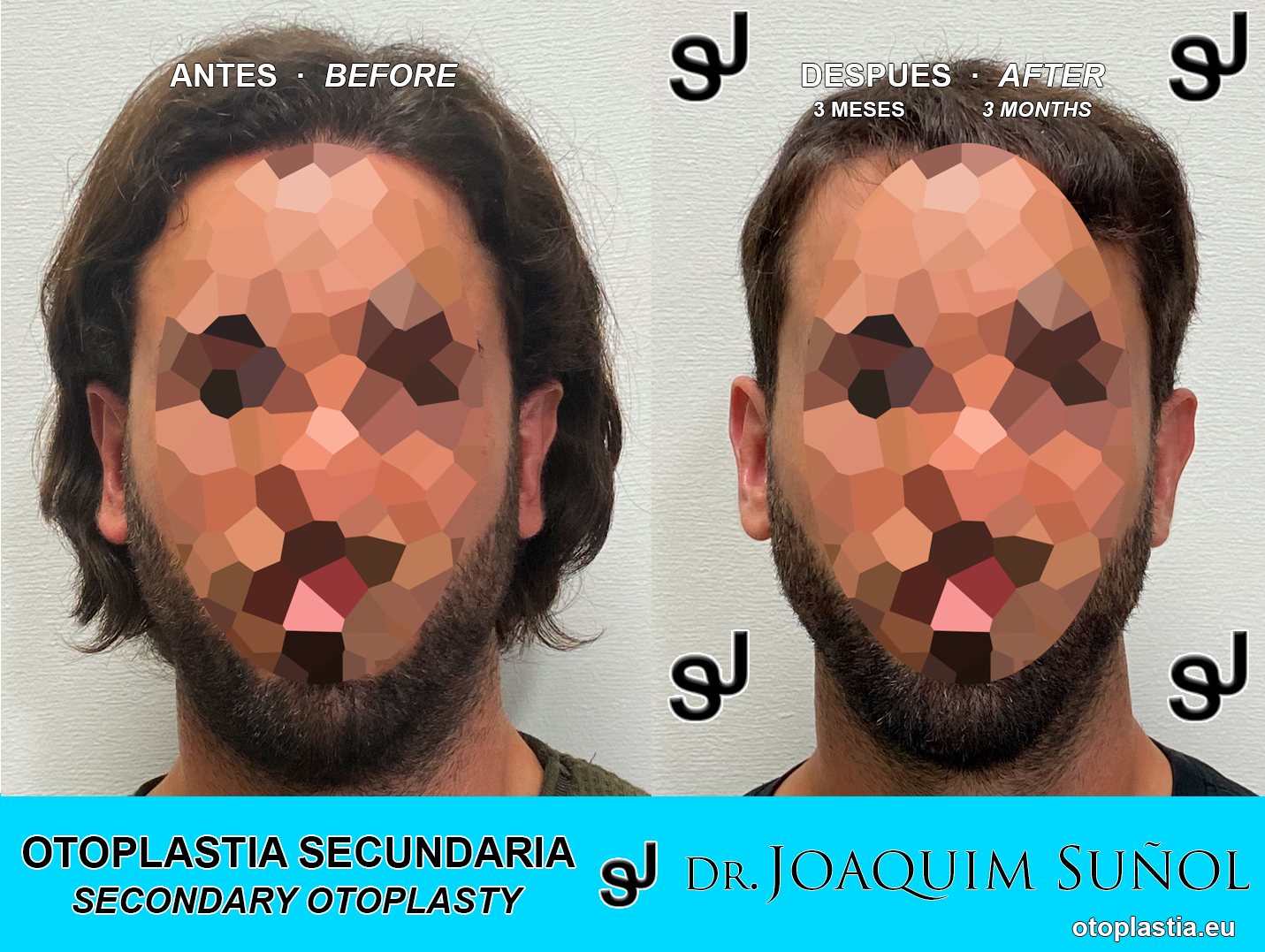 Otoplastia secundaria - Dr. Joaquim Suñol