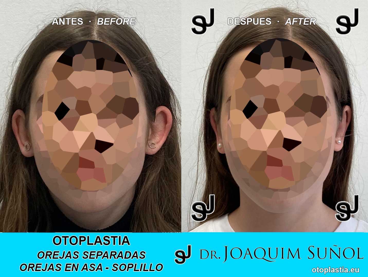 Otoplastia - Dr. Joaquim Suñol