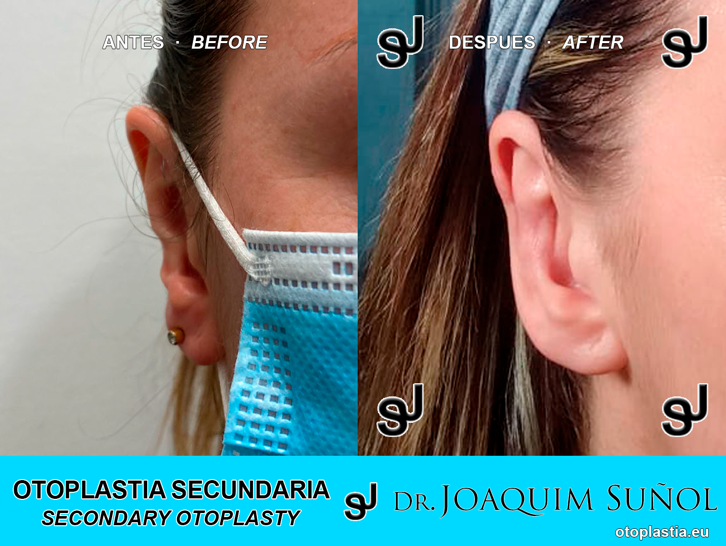 Reoperacion de orejas - otoplastia secundaria: Resultados reales Antes y Despues
