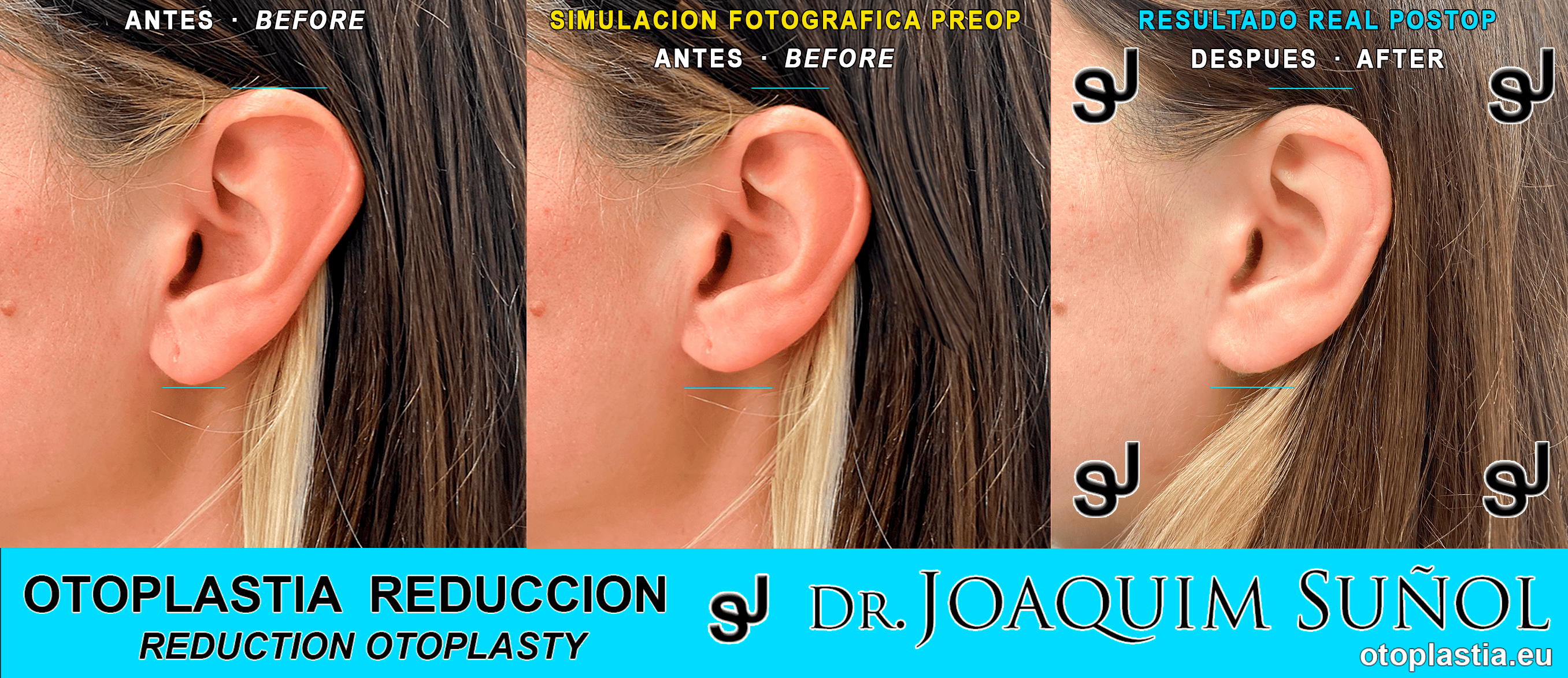 ear reduction otoplasty